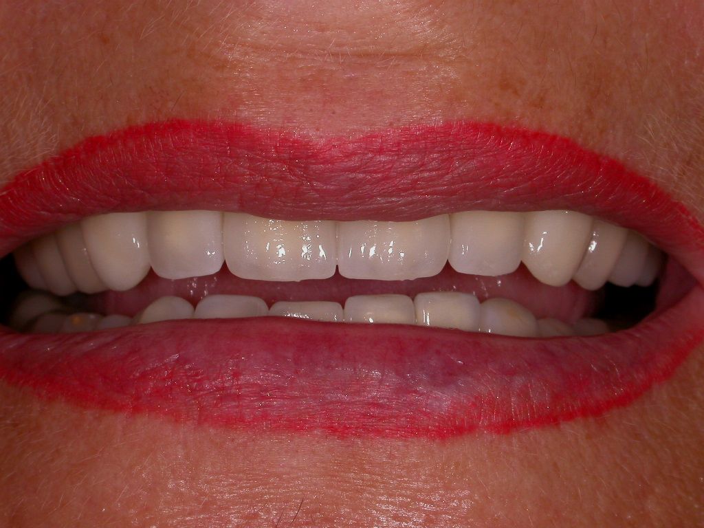 Strahlende Vollkeramik-Kronen; unten festsitzende Kronen auf neu gesetzten Implantaten